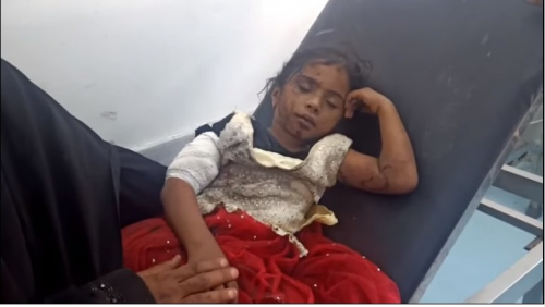  . إصابة 7 أشخاص من أسرة واحدة بينهم 4 أطفال بانفجار لغم حوثي في مديرية حيس